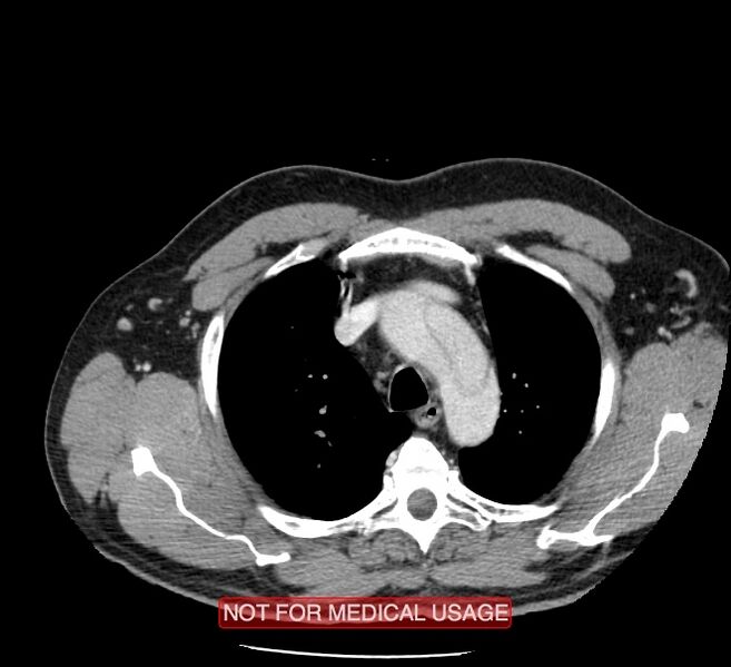 File:Acute aortic dissection - Stanford type A (Radiopaedia 40661-43285 Axial C+ portal venous phase 1).jpg