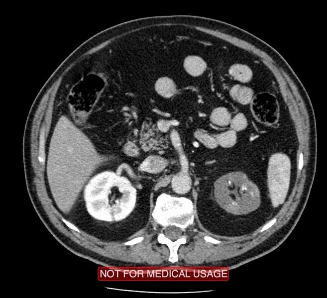 File:Acute aortic dissection - Stanford type A (Radiopaedia 40661-43285 Axial C+ portal venous phase 93).jpg