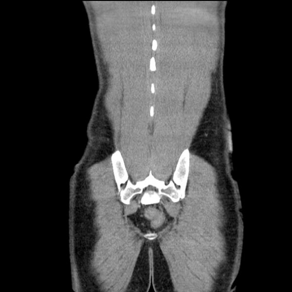 File:Acute appendicitis (Radiopaedia 27049-27227 Coronal C+ portal venous phase 54).jpg