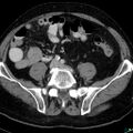 Acute appendicitis arising from a malrotated cecum (Radiopaedia 19970-19997 Axial C+ portal venous phase 27).jpg