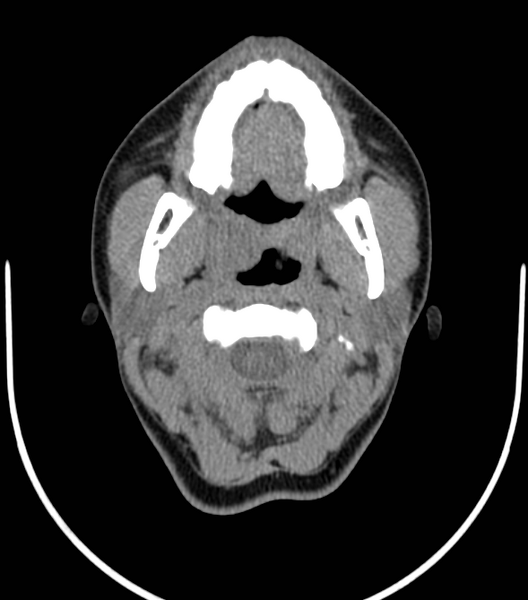 File:Acute bacterial tonsillitis (Radiopaedia 22882-22908 Axial non-contrast 14).png