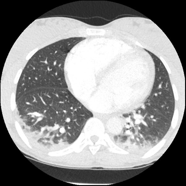File:Acute chest syndrome - sickle cell disease (Radiopaedia 42375-45499 Axial lung window 126).jpg