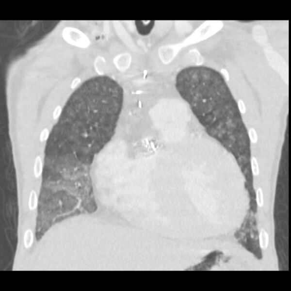 File:Acute diffuse alveolar hemorrhage (Radiopaedia 41323-44158 Coronal lung window 11).jpg