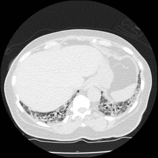 File:Acute interstitial pneumonitis (Radiopaedia 45404-49444 Axial lung window 85).jpg