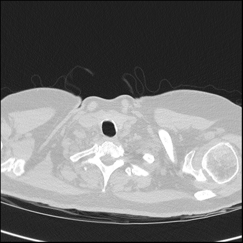 Acute interstitial pneumonitis (Radiopaedia 45404-49453 Axial lung window 2).jpg