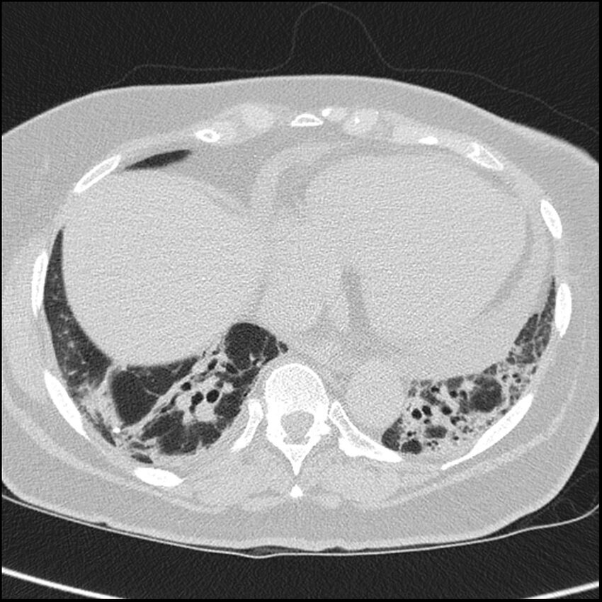 Acute interstitial pneumonitis (Radiopaedia 45404-49453 Axial lung window 59).jpg