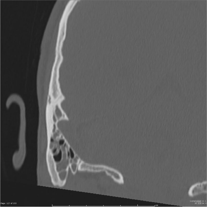 Acute otomastoiditis (Radiopaedia 28276-28512 Coronal PTB bone window reformat 58).jpg