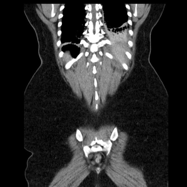 File:Acute pancreatitis - Balthazar C (Radiopaedia 26569-26714 Coronal C+ portal venous phase 59).jpg