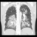 Acute pulmonary edema on CT (Radiopaedia 33582-34672 Coronal lung window 26).jpg