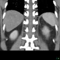 Acute pyelonephritis and emphysematous pyonephrosis (Radiopaedia 27893-28128 Coronal renal cortical phase 17).jpg