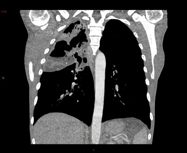 File:Acute right lung abscess (Radiopaedia 34806-36258 Coronal C+ arterial phase 20).jpg