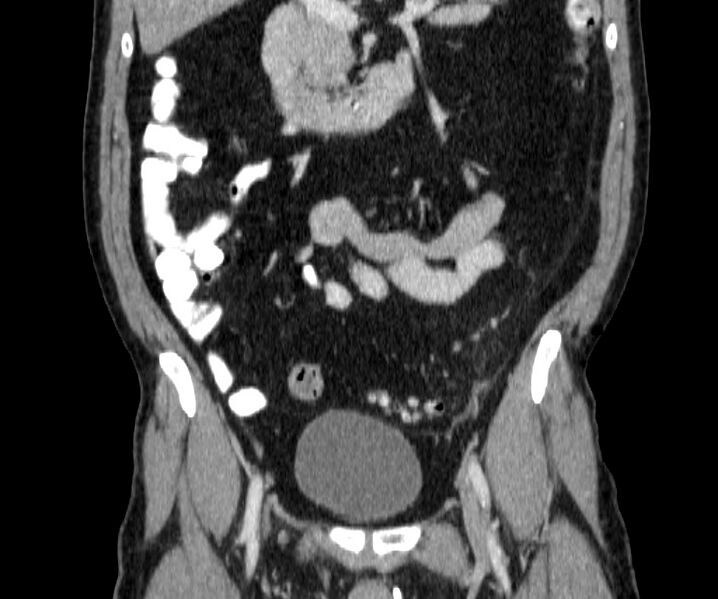 File:Acute sigmoid colon diverticulitis (Radiopaedia 55507-61976 Coronal C+ portal venous phase 63).jpg