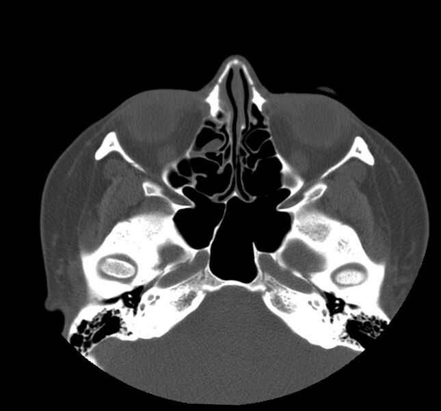 File:Acute sinusitis (Radiopaedia 22419-22455 Axial non-contrast 17).jpg