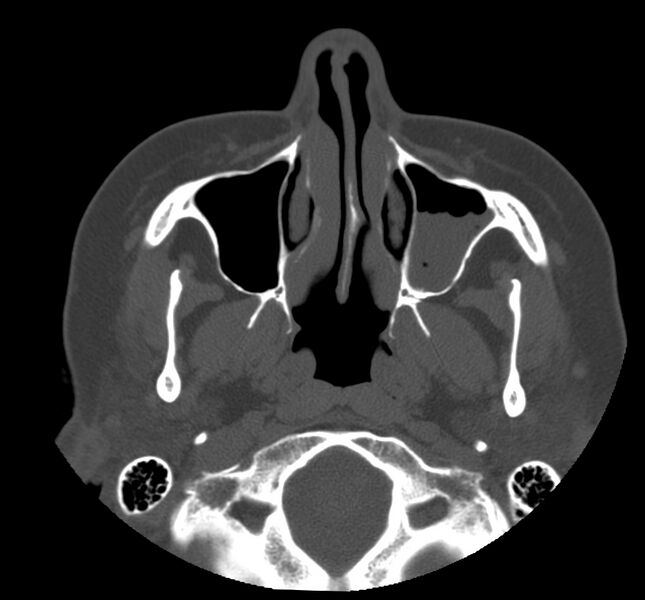 File:Acute sinusitis (Radiopaedia 22419-22455 Axial non-contrast 9).jpg