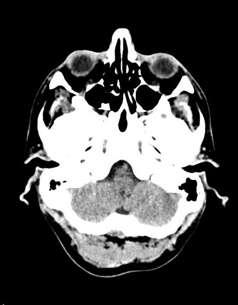 File:Acute superior cerebellar artery territory infarct (Radiopaedia 84104-99359 Axial non-contrast 56).jpg