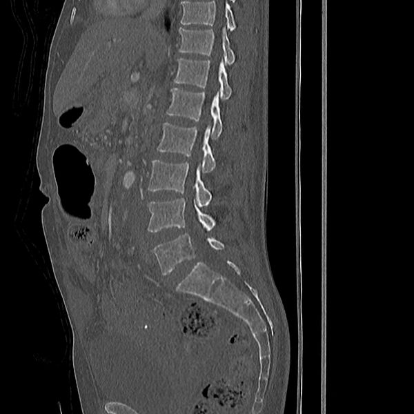 File:Acute vertebral body compression fractures (Radiopaedia 31757-32693 Sagittal bone window 29).jpg