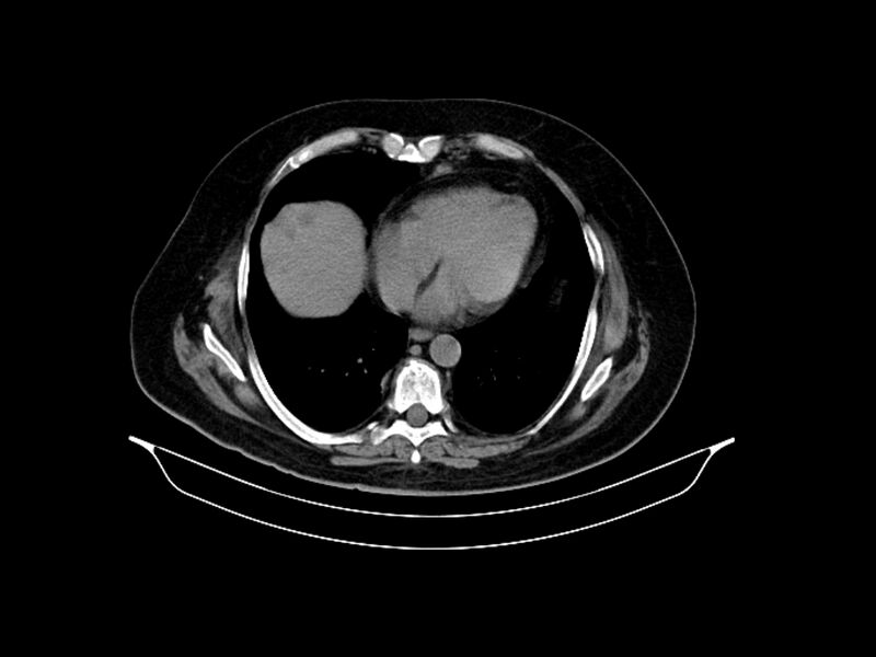 File:Adenocarcinoma of pancreas with hepatic metastasis (Radiopaedia 64332-73122 Axial non-contrast 13).jpg