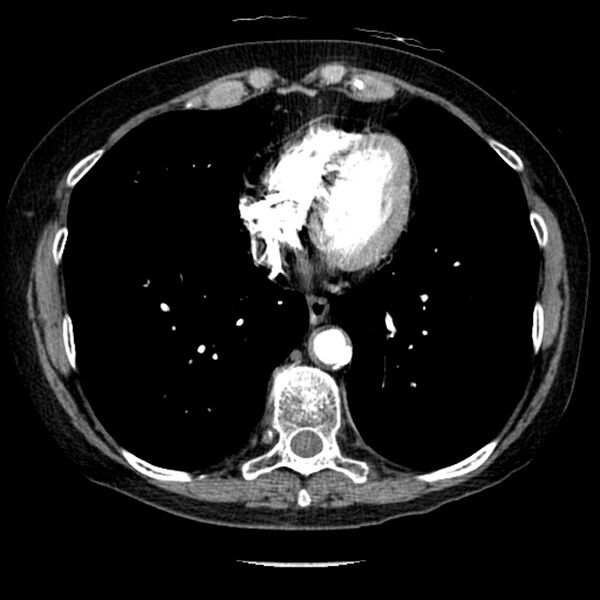 File:Adenocarcinoma of the lung (Radiopaedia 41015-43755 Axial C+ portal venous phase 84).jpg