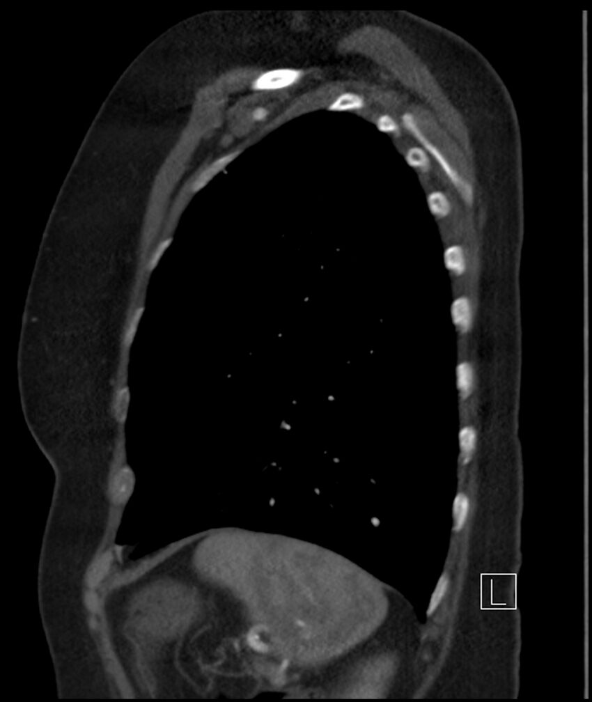 Adenocarcinoma of the lung (Radiopaedia 44205-47803 Sagittal C+ portal venous phase 12).jpg
