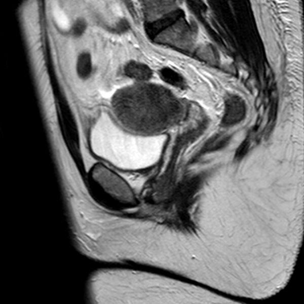 File:Adenomyoma of the uterus (Radiopaedia 9871-10439 Sagittal T2 16).jpg