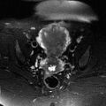Adenomyosis of the uterus (Radiopaedia 9869-10437 Axial T2 4).jpg