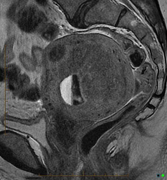 File:Adenomyosis uterus with hematometra (Radiopaedia 45779-50011 Sagittal T2 15).jpg