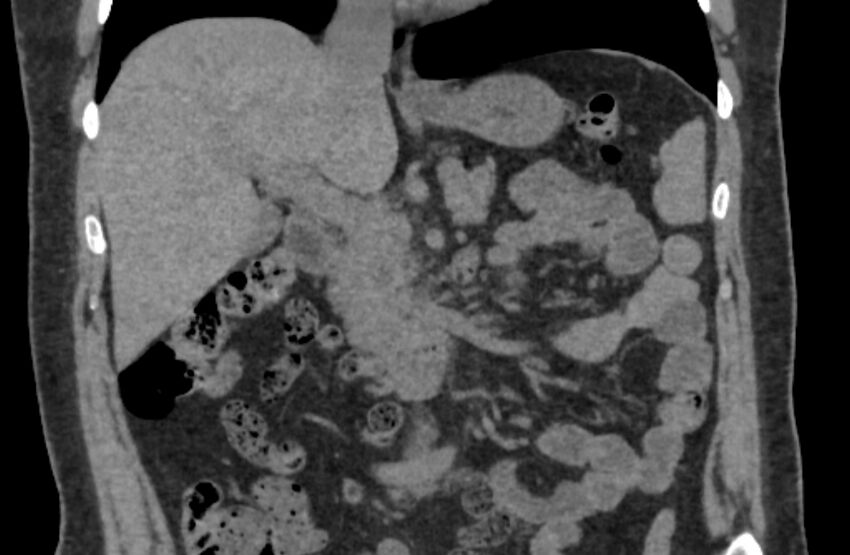 Adrenal myelolipoma (Radiopaedia 65240-74253 Coronal non-contrast 2).jpg