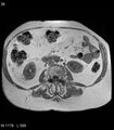 Adrenal myelolipoma (Radiopaedia 6765-7961 Axial T1 in-phase 36).jpg