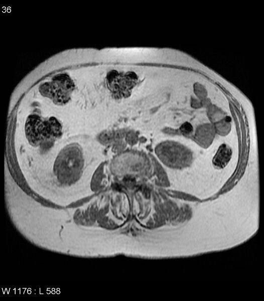 File:Adrenal myelolipoma (Radiopaedia 6765-7961 Axial T1 in-phase 36).jpg