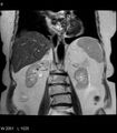 Adrenal myelolipoma (Radiopaedia 6765-7961 Coronal T2 6).jpg