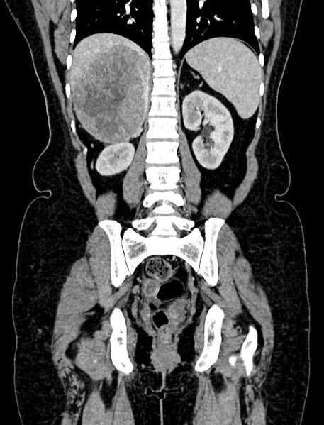 File:Adrenocortical carcinoma (Radiopaedia 87281-103569 Coronal C+ portal venous phase 89).jpg
