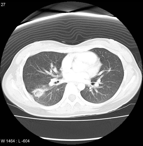 File:Air crescent sign (aspergilloma) (Radiopaedia 14380-14306 Axial lung window 9).jpg