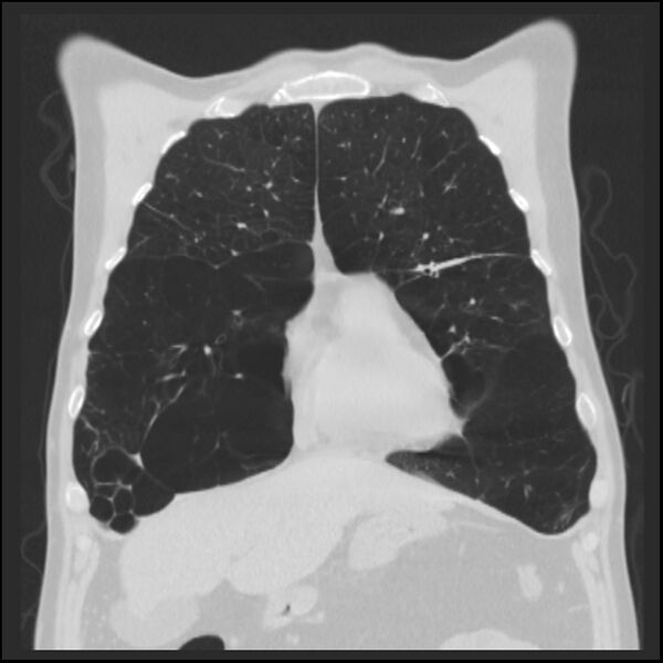 File:Alpha-1-antitrypsin deficiency (Radiopaedia 40993-43722 Coronal lung window 25).jpg