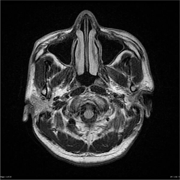 File:Amnestic syndrome secondary to hypoxic brain injury (Radiopaedia 24743-25004 FLAIR 1).jpg