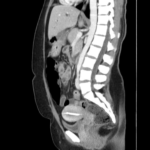 File:Ampullary tumor (Radiopaedia 22787-22816 D 30).jpg