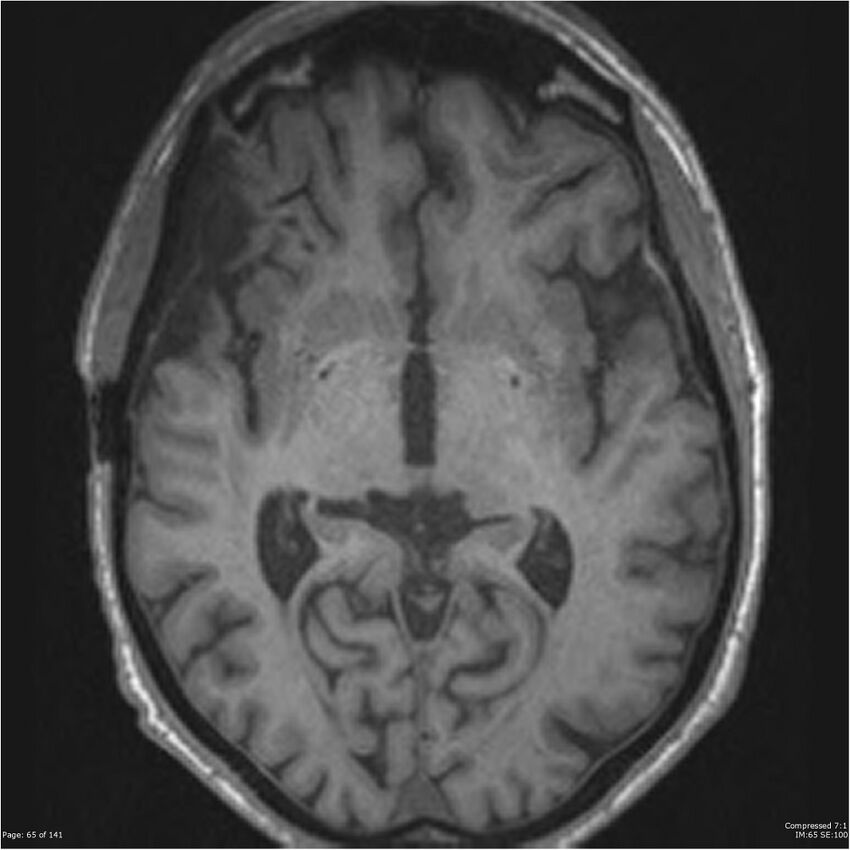 Anaplastic meningioma with recurrence (Radiopaedia 34452-35788 Axial T1 63).jpg