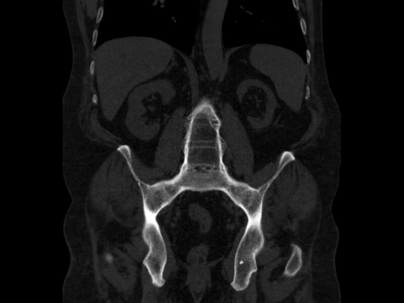 File:Ankylosing spondylitis (Radiopaedia 44609-48357 Coronal bone window 52).jpg