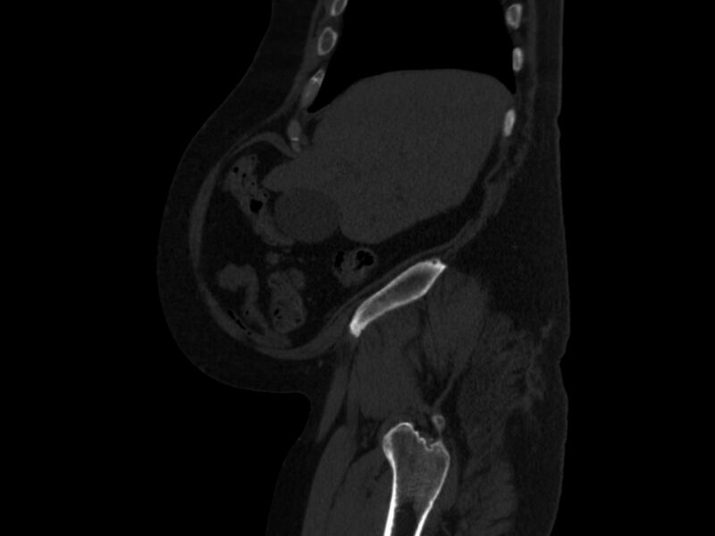 File:Ankylosing spondylitis (Radiopaedia 44609-48357 Sagittal bone window 9).jpg