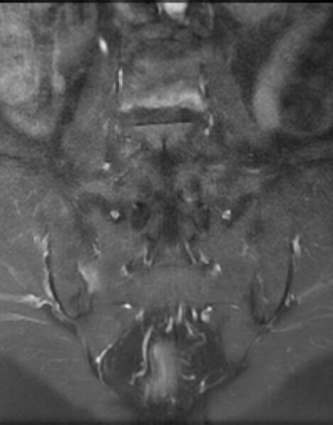File:Ankylosing spondylitis - Andersson lesion (Radiopaedia 81878-95838 H 8).jpg