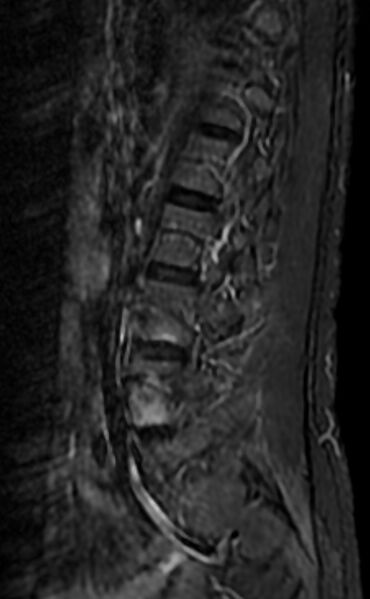 File:Ankylosing spondylitis - Andersson lesion (Radiopaedia 81878-95838 Sagittal STIR 3).jpg