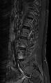 Ankylosing spondylitis - Andersson lesion (Radiopaedia 81878-95838 Sagittal STIR 3).jpg