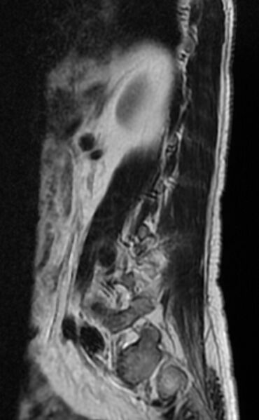 File:Ankylosing spondylitis - Andersson lesion (Radiopaedia 81878-95838 Sagittal T2 11).jpg