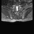 Ankylosing spondylitis with zygapophyseal arthritis (Radiopaedia 38433-40517 D 15).jpg