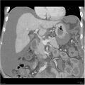 Annular pancreas and cirrhosis (Radiopaedia 24561-24843 B 7).jpg