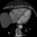 Anomalous origin of left circumflex artery from right coronary sinus (Radiopaedia 72563-83117 B 126).jpg