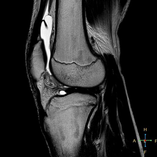 File:Anterior cruciate ligament tear - complete (Radiopaedia 24907-25170 Sagittal T2 6).jpg