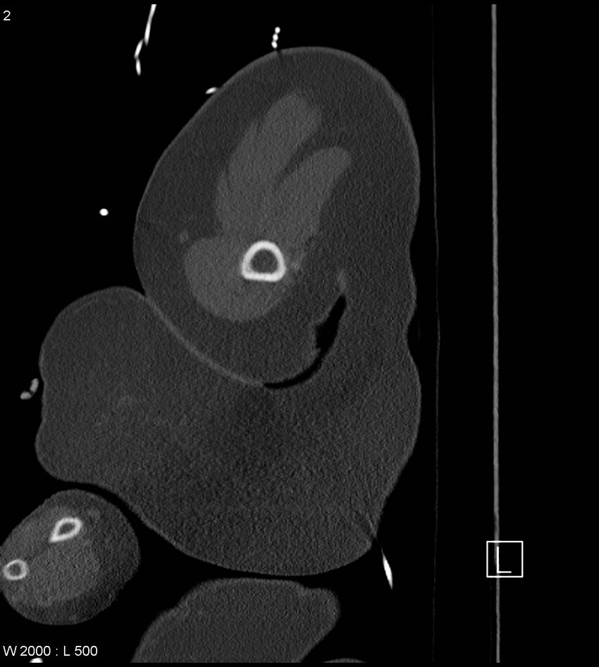 Anterior shoulder dislocation (CT) (Radiopaedia 59032-66309 Sagittal bone window 1).jpg