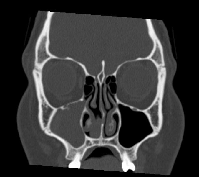 File:Antrochoanal polyp (Radiopaedia 21894-21868 Coronal bone window 10).jpg