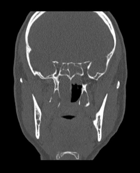 File:Antrochoanal polyp (Radiopaedia 79011-92169 Coronal bone window 27).jpg