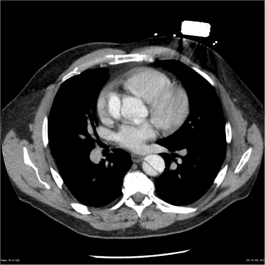 Aortic dissection- Stanford A (Radiopaedia 37759-39664 A 37).jpg